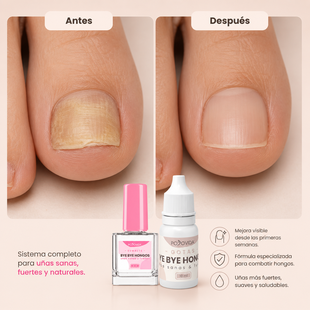 Kit ByeBye Hongos – Uñas Sanas & Cuidadas