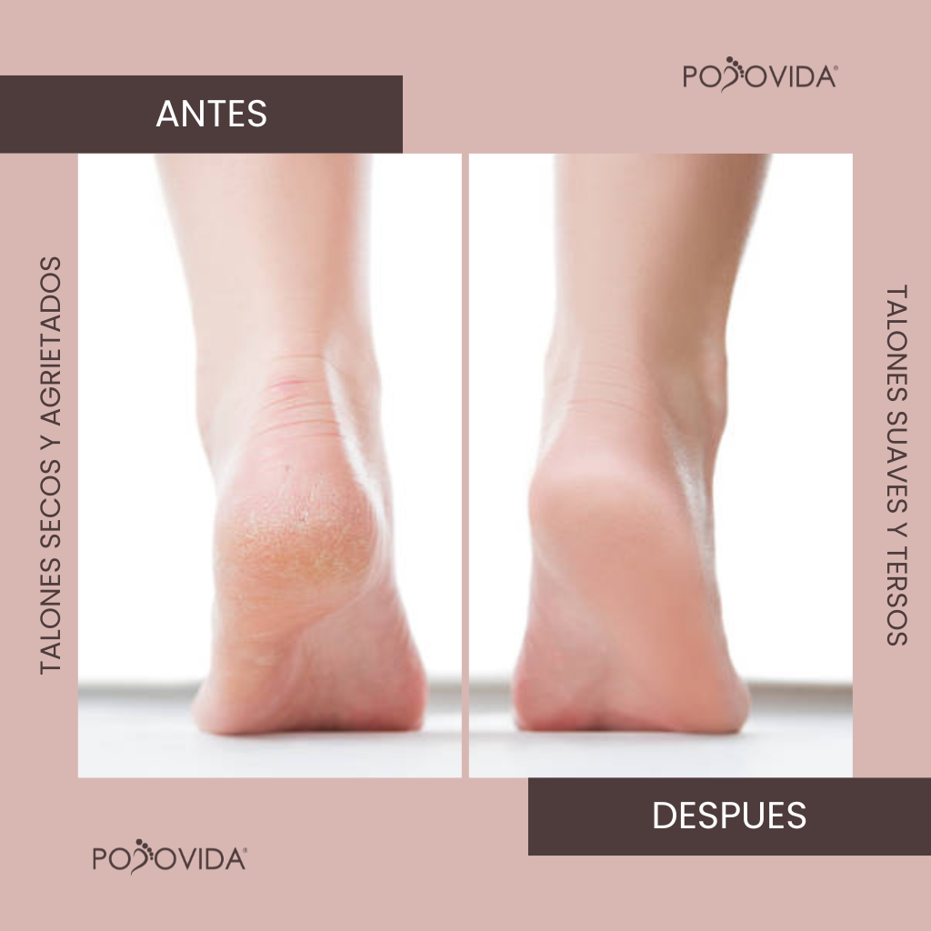 Crema Urea 40% - 50ml - PodoVida